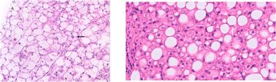 Hepatopathy Associated With Type 1 Diabetes: Distinguishing Non-alcoholic Fatty Liver Disease From Glycogenic Hepatopathy